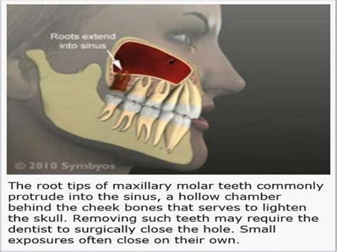Consequently, inflammation in the sinuses might cause pain in nearby teeth. . Tooth extraction when root is in sinus cavity reddit